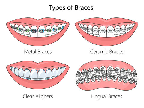 Comparing Different Types of Braces